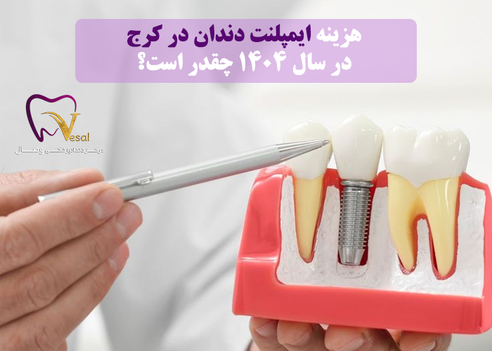 قیمت ایمپلنت دندان در کرج در سال 1404