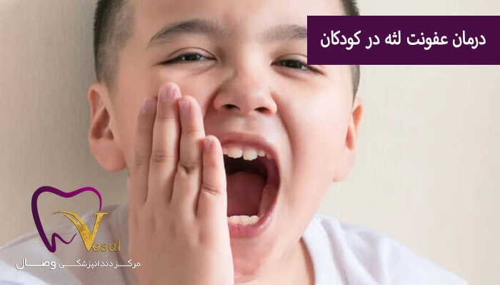 درمان عفونت لثه در کودکان