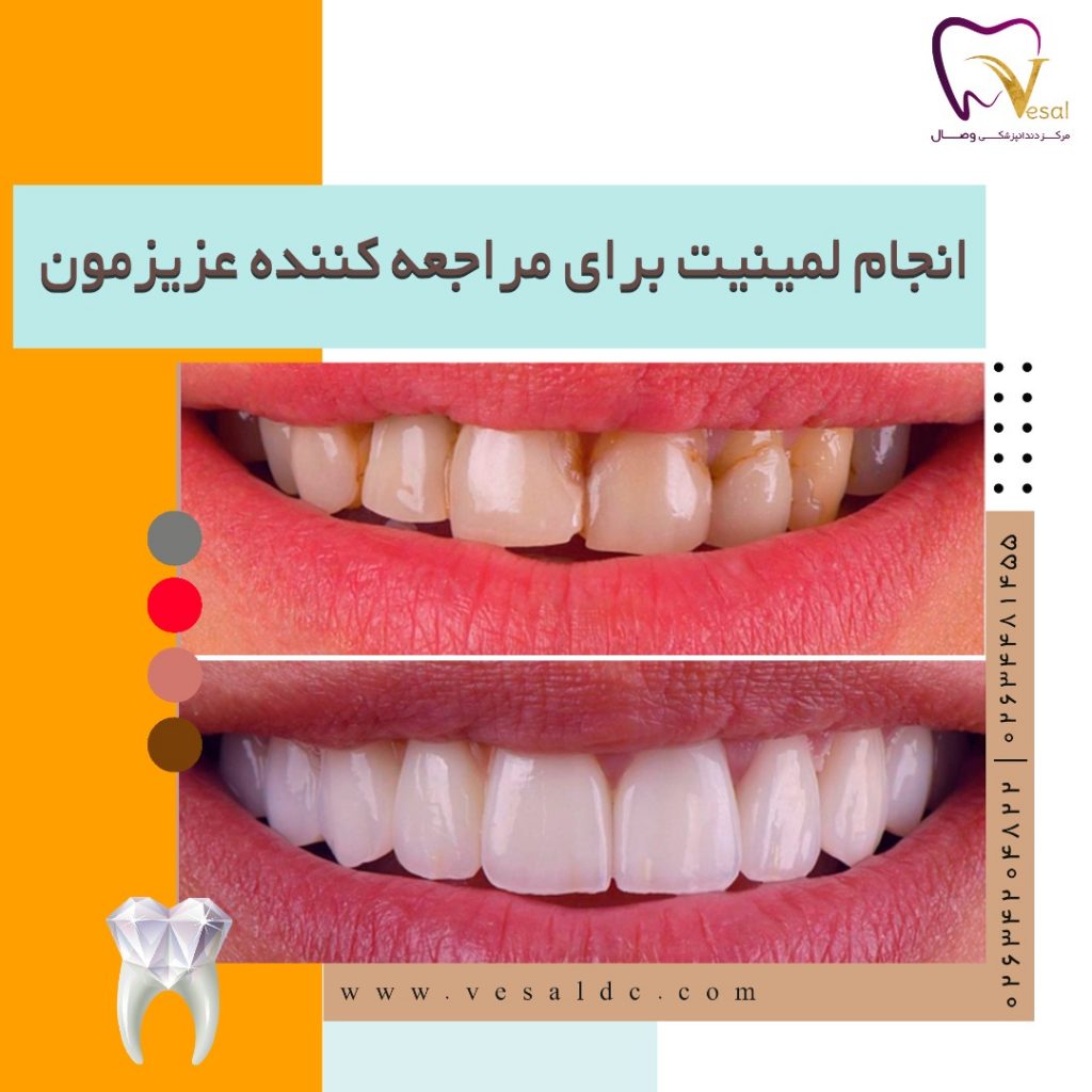 نمونه ای از لمینت دندان در دندانپزشکی وصال