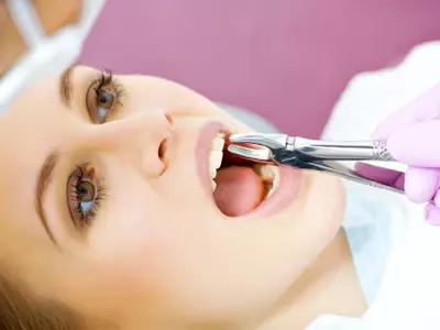جراحی کشیدن دندان