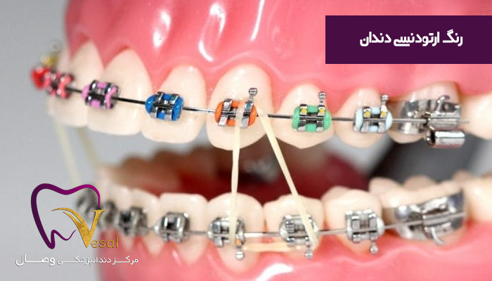 بهترین رنگ ارتودنسی
