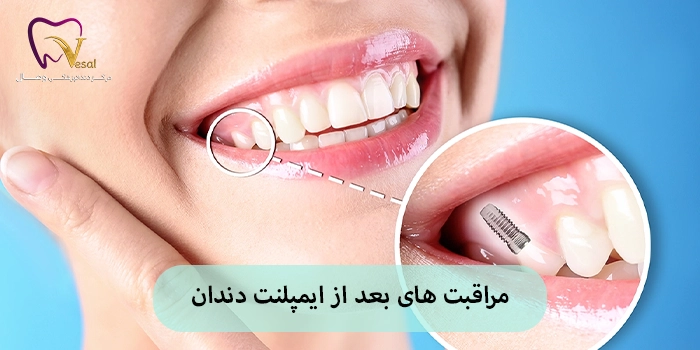 مراقبت های بعد از ایمپلنت