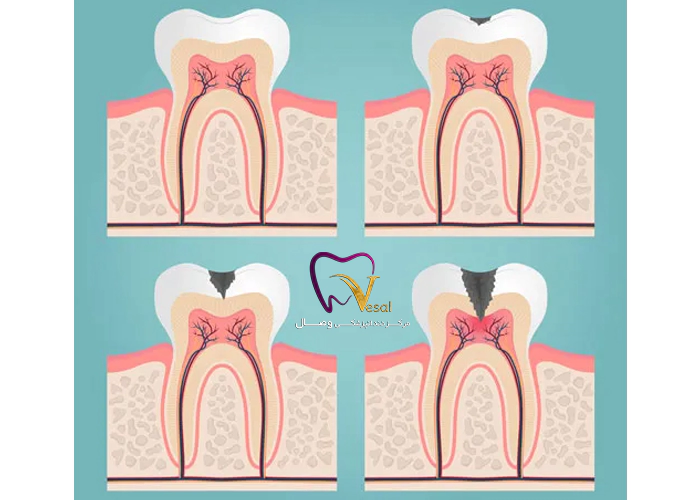 چگونه از به عصب رسیدن دندان پیشگیری کنیم؟