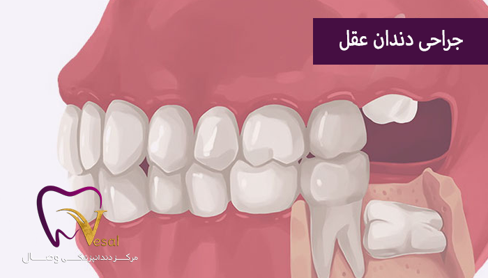 جراحی دندان عقل