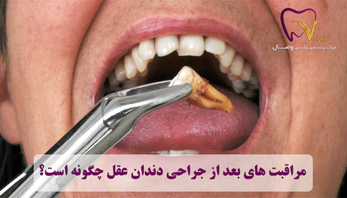 مراقبت های بعد از جراحی دندان عقل چگونه است؟