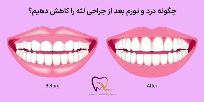 چگونه درد و تورم بعد از جراحی لثه را کاهش دهیم؟