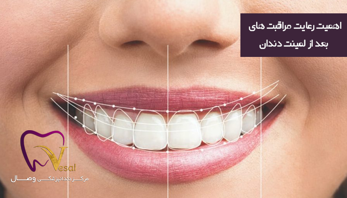 اهمیت رعایت مراقبت های بعد از لمینت دندان