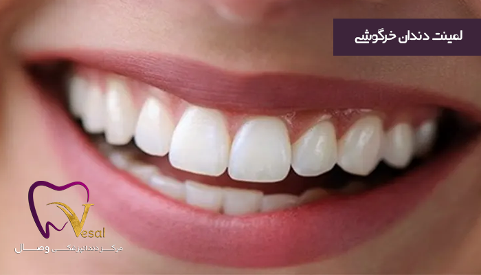 مزایای لمینت دندان خرگوشی