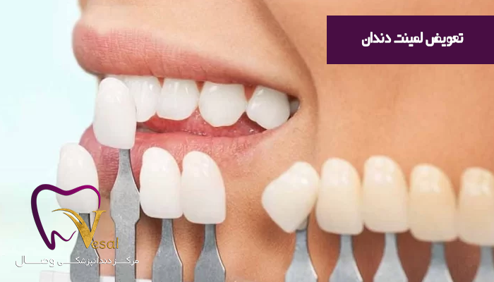 دلایل نیاز به تعویض لمینت دندان