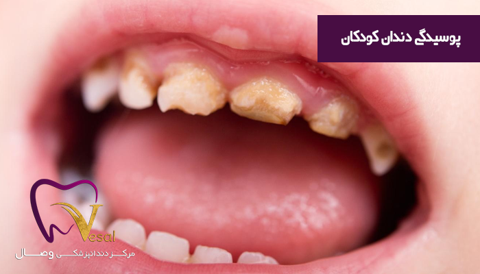 پوسیدگی دندان کودکان