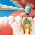 درمان ریشه دندان