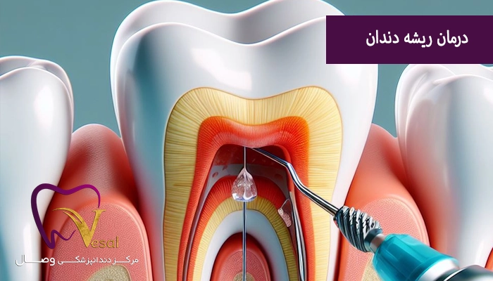 چه زمانی درمان ریشه دندان لازم است؟