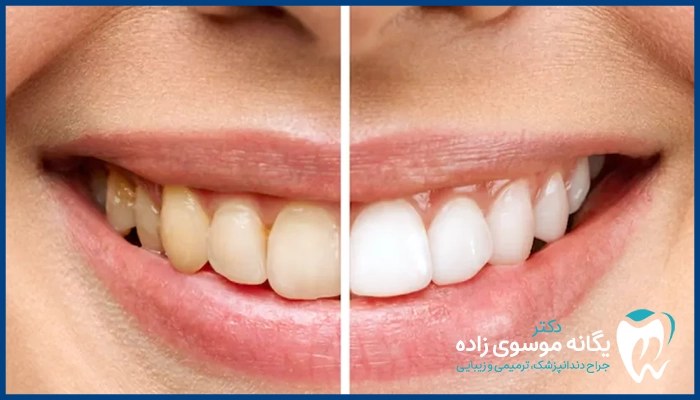 علت تغییر رنگ کامپوزیت دندان