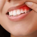 بیماری لثه