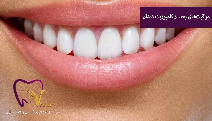 نکات مراقبتی در روزهای اول بعد از کامپوزیت دندان
