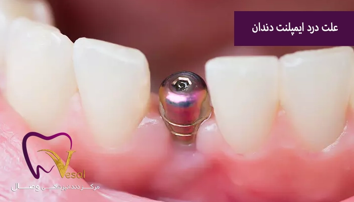 علت درد بعد از ایمپلنت دندان چیست؟