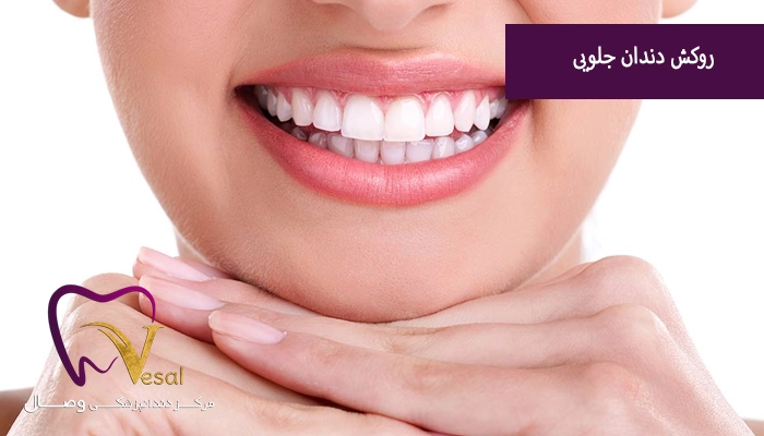 روکش دندان جلو چه کابردی دارد؟