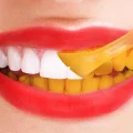 زرد شدن کامپوزیت دندان
