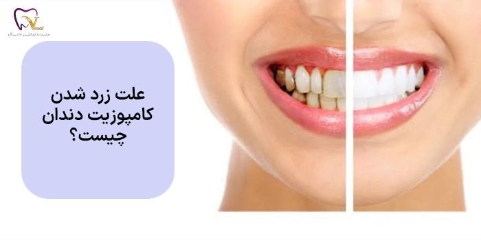 علت زرد شدن کامپوزیت دندان چیست؟