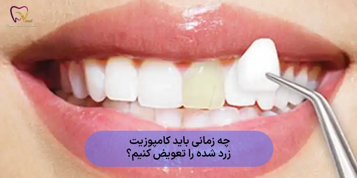 چه زمانی باید کامپوزیت زرد شده را تعویض کنیم؟